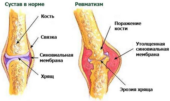 revmatizm-sustava.jpg