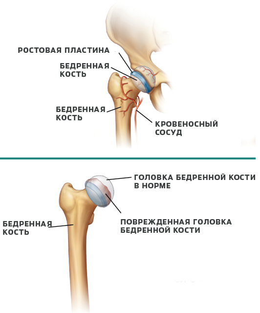 legg-calve-perthes-disease.jpg