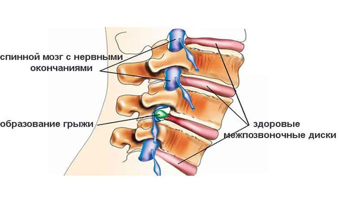 о-шейной-грыжи-и-лечению.jpg