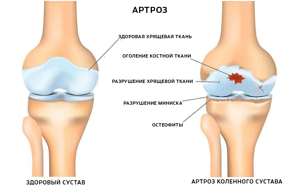 artroz-kolennogo-sustava.jpg