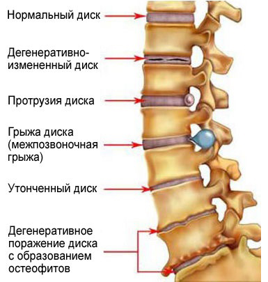 stadii-osteohondroza-poiasnichno-krestcovogo-otdela-pozvonochnika.jpg