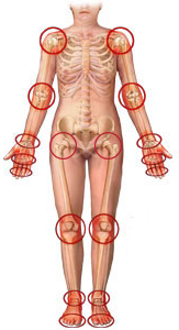 zony-porazhenija-revmaticheskogo-poliartrita.jpg