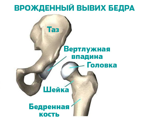 Врожденный вывих бедра.jpg